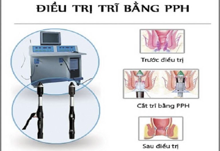 cắt trĩ phương pháp nào tốt nhất