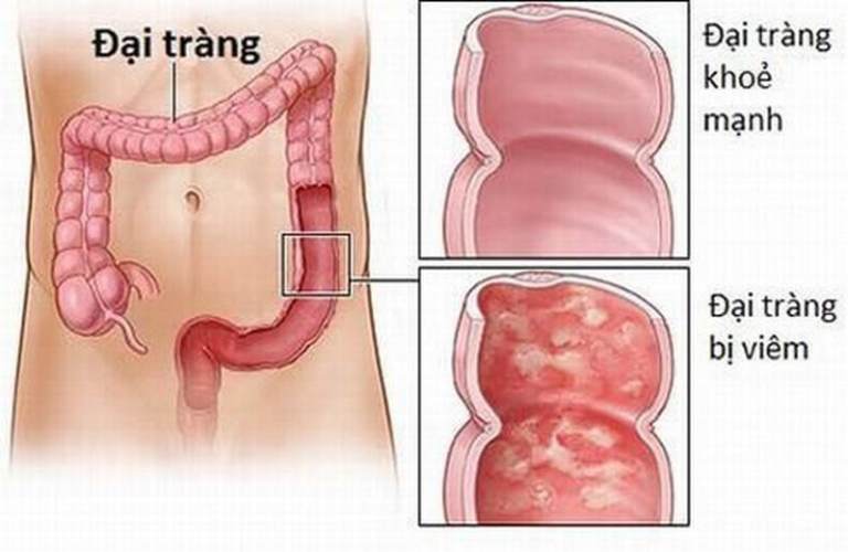 Bệnh viêm đại tràng 