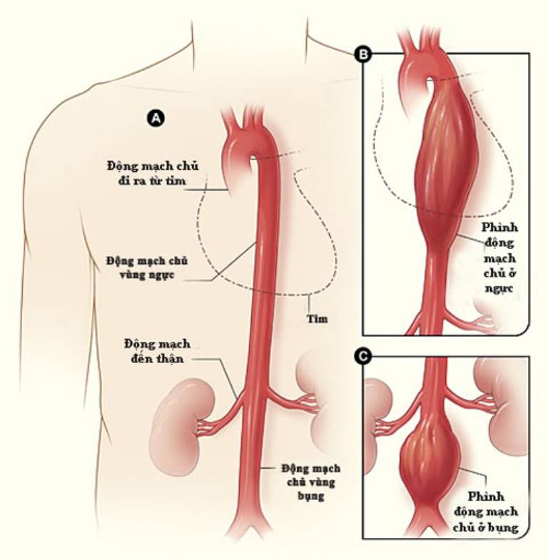 Phình động mạch chủ là hiện tượng vô cùng nguy hiểm có thể gây tử vong