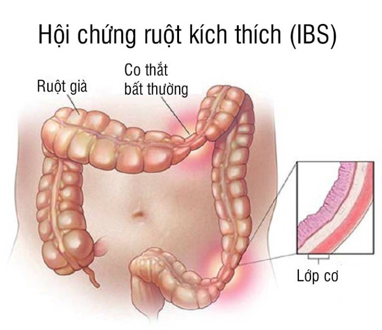 Đau quặn bụng từng cơn có thể là dấu hiệu của hội chứng ruột kích thích
