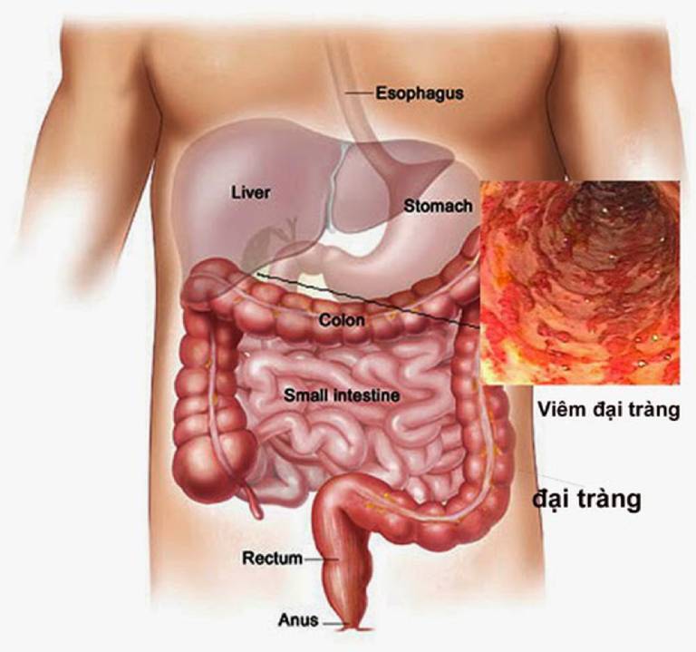 Do bệnh lý về tiêu hóa