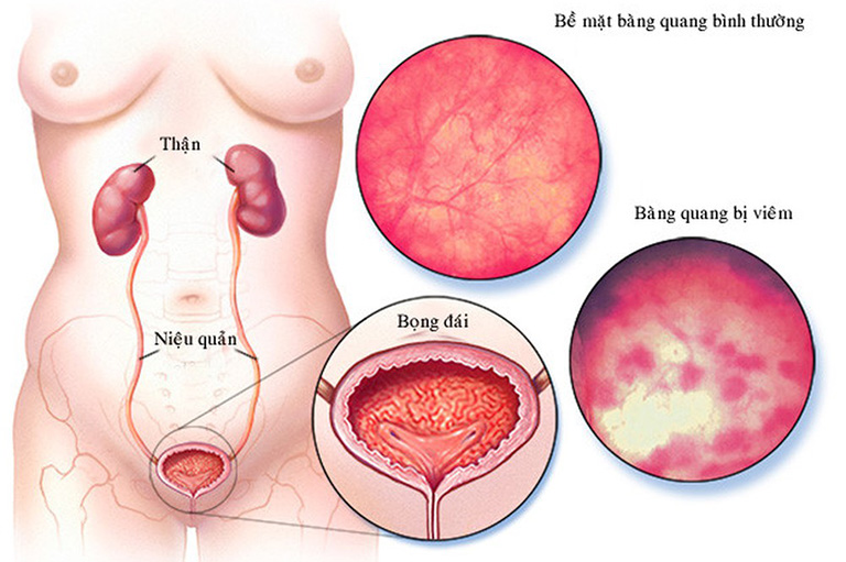 đi tiểu không hết là bệnh gì