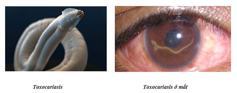 điều trị bệnh Toxocariasis