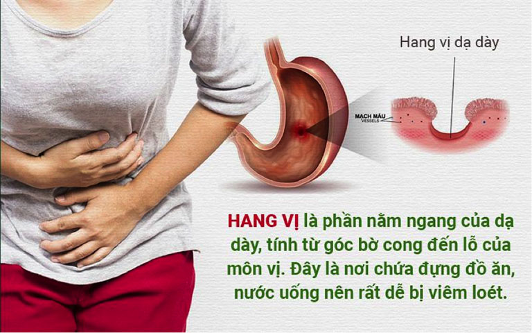 Hang vị dạ dày