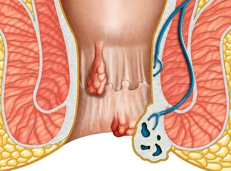 mổ trĩ xong bao lâu thì khỏi