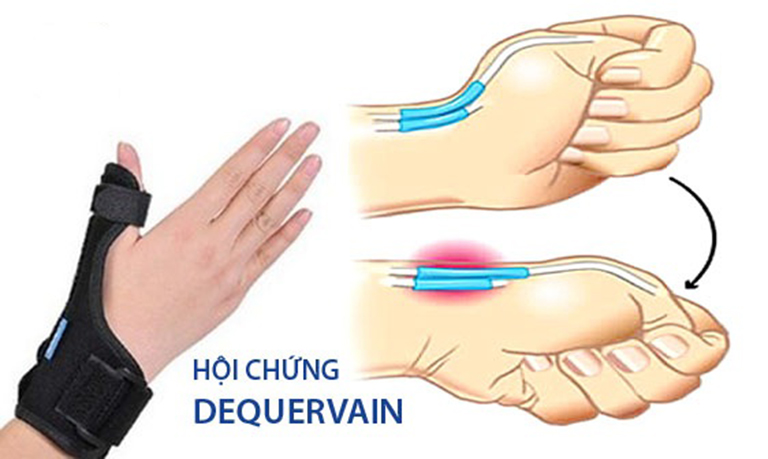 Hội chứng De Quervain thường gặp ở phụ nữ mang thai, người bị thấp khớp, tiểu đường