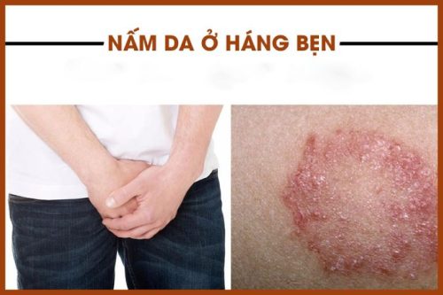 Nấm bẹn là tình trạng thường gặp ở nam giới