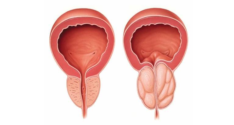 U nang tuyến tiền liệt là gì?