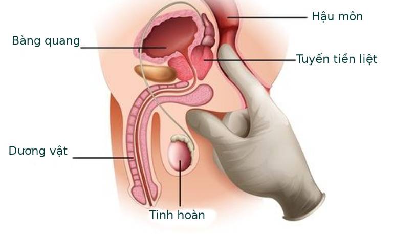 U nang tuyến tiền liệt có nguy hiểm không?