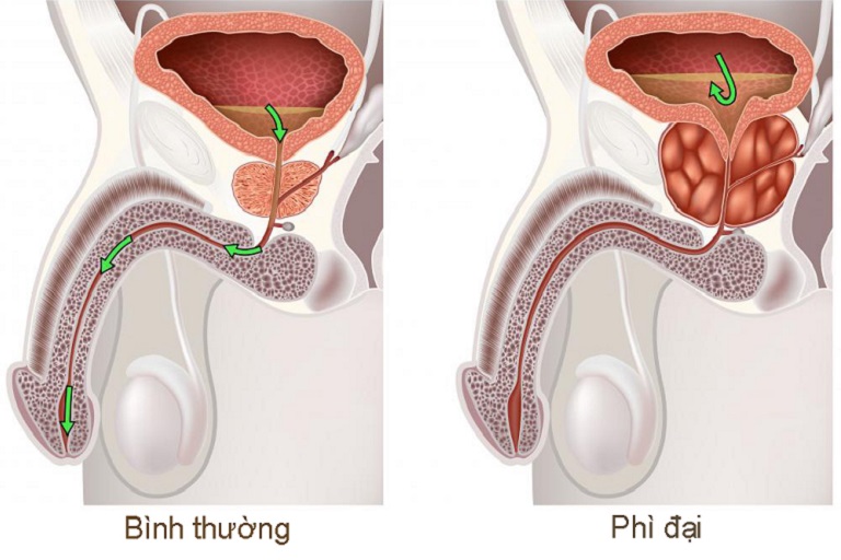 Bí tiểu ở người già 