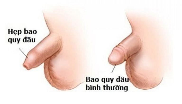 những bệnh nam khoa thường gặp