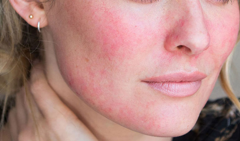 Bệnh Rosacea