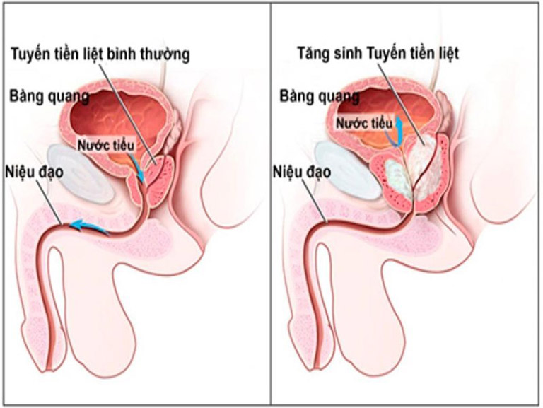 Thông tin cần biết về bệnh u phì đại lành tính tuyến tiền liệt