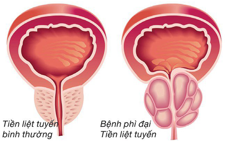 Bệnh phì đại tuyến tiền liệt