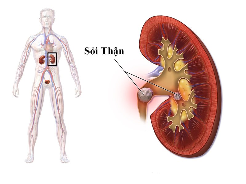 Sỏi thận là nguyên nhân gây bệnh tiểu rắt ở nam giới