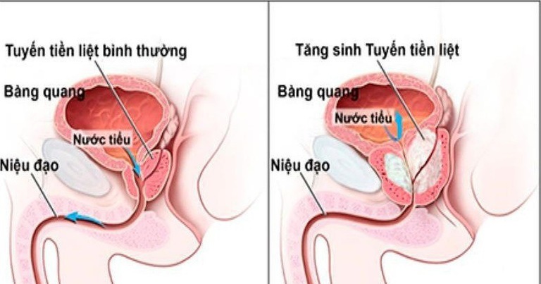 Cần hiểu tuyến tiền liệt có kích thước to không hẳn là mắc bệnh