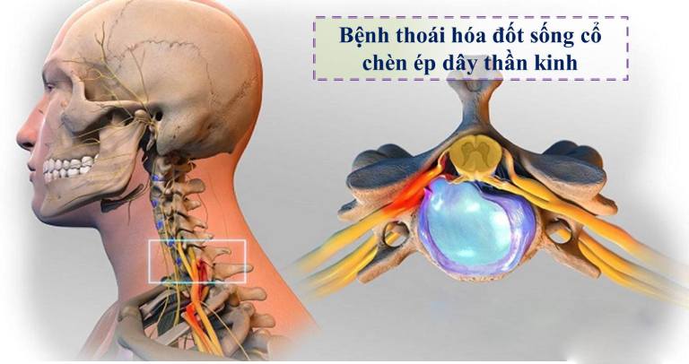 Thoái hóa đốt sống cổ chèn dây thần kinh là gì?