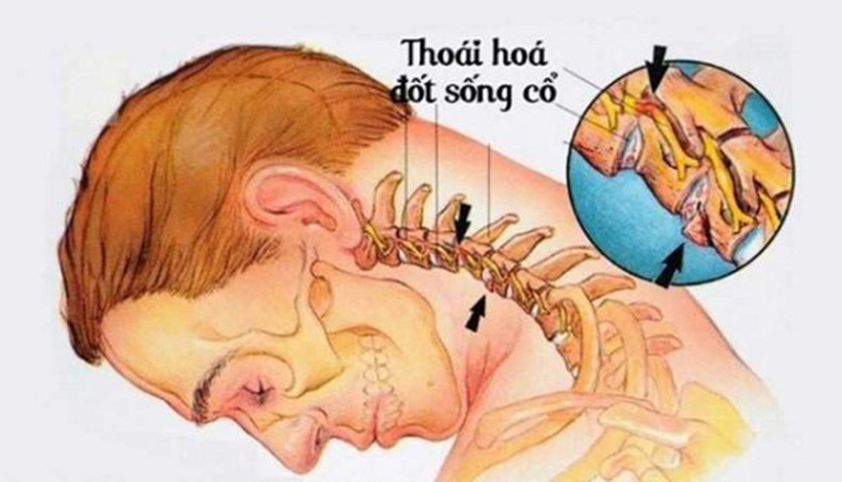 Thoái hóa đốt sống cổ có nguy hiểm không?