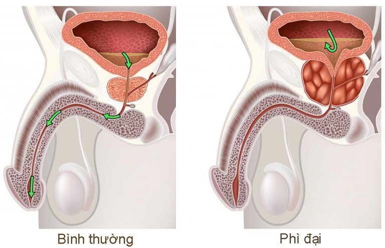 Phì đại tiền liệt tuyến uống thuốc gì?