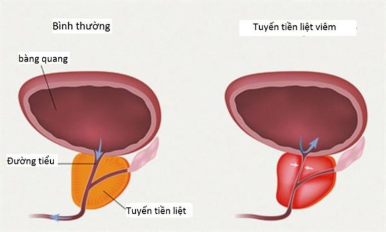 Chứng tiểu buốt ở nam giới cũng có thể xuất hiện do tuyến tiền liệt bị viêm