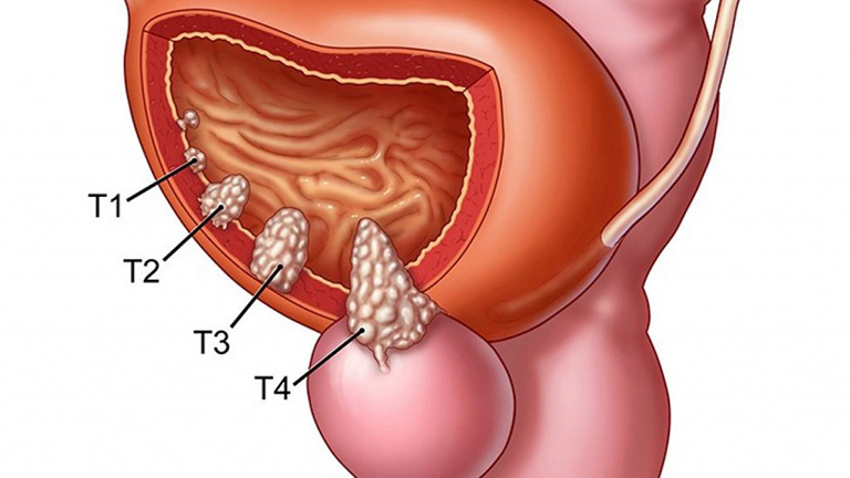 tiểu buốt ra máu là bệnh gì