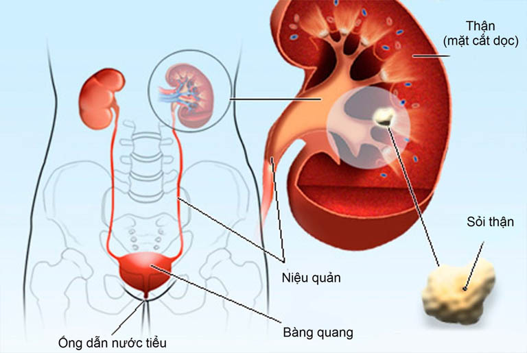 tiểu ra máu ở phụ nữ là bệnh gì