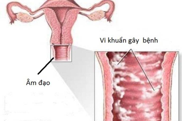 Âm đạo bị viêm nhiễm ảnh hưởng đến bàng quang và tiết niệu