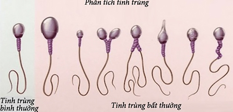 Tinh trùng dị dạng là gì?