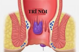 Trĩ nội nằm ở trên đường lược, trĩ ngoại thì nằm ở dưới