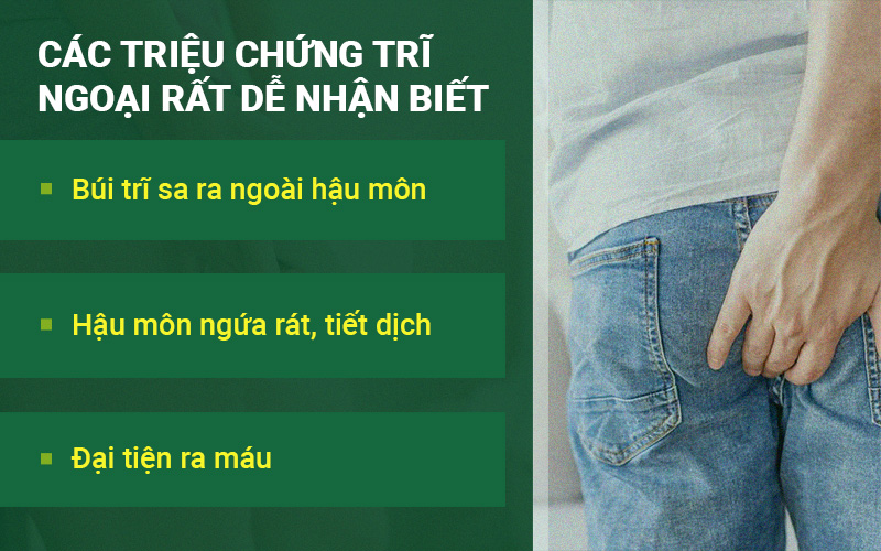 Các triệu chứng trĩ ngoại