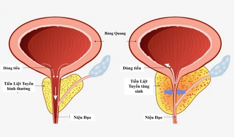 Nguyên nhân gây ra các nốt vôi hóa tiền liệt tuyến