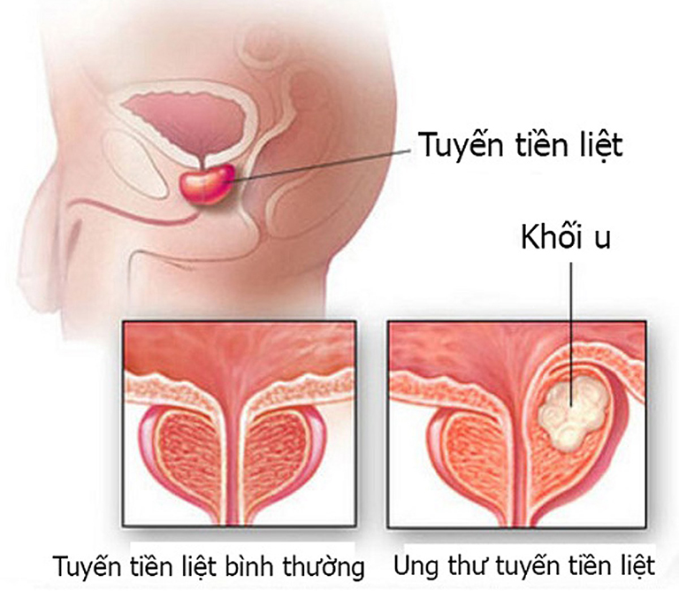 Bệnh ung thư tuyến tiền liệt