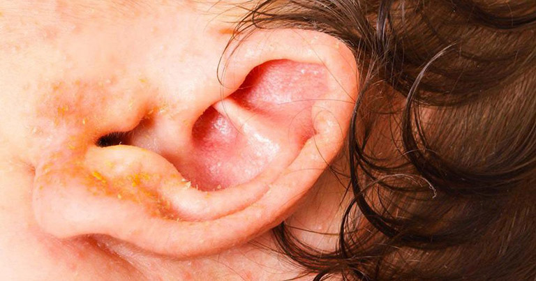 Nguyên nhân khiến vành tai bị ngứa và chảy nước vàng