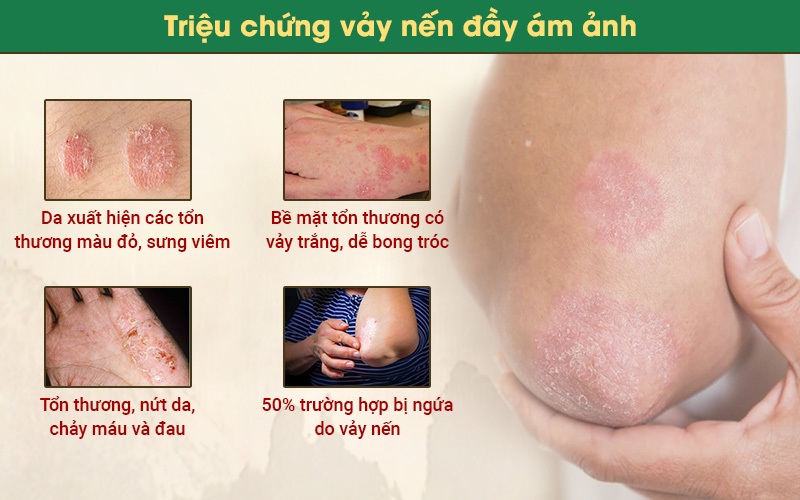 triệu chứng vảy nến