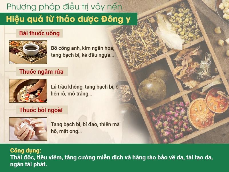 Điều trị vảy nến bằng thảo dược đông y