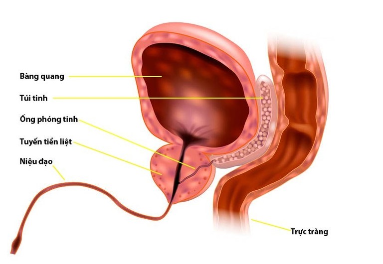 Nốt vôi hóa tiền liệt tuyến là gì?