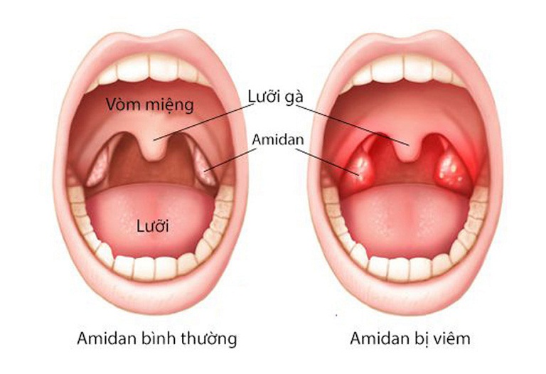 viêm amidan có tự khỏi được không 