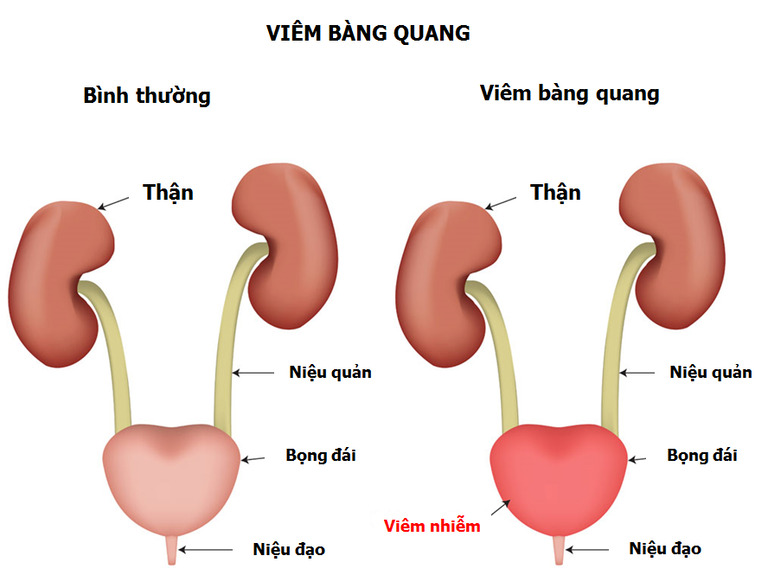 Đi tiểu buốt ra máu sau khi quan hệ: Nguyên nhân, Triệu chứng và Giải pháp