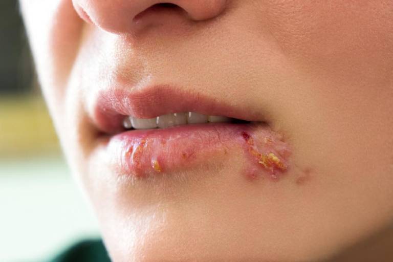 Bệnh herpes