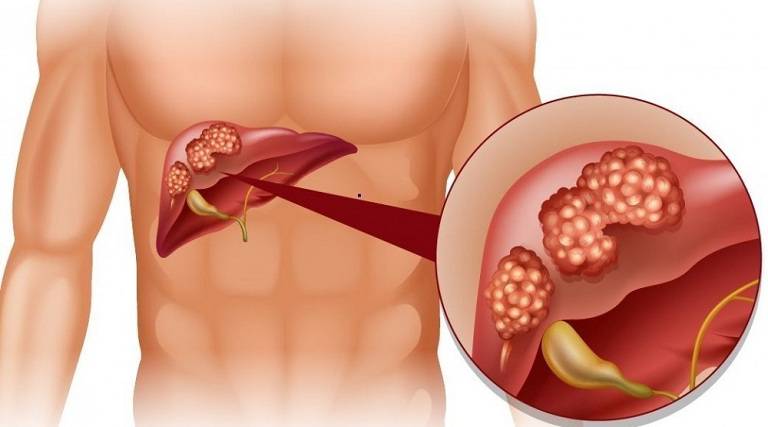 Nguyên nhân gây đầy bụng khó tiêu buồn nôn