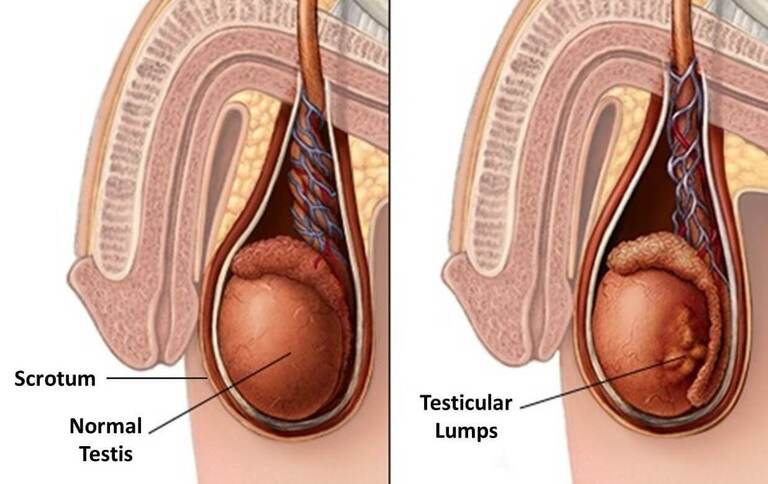 Tinh trùng vón cục màu vàng có thể là dấu hiệu của nhiều bệnh