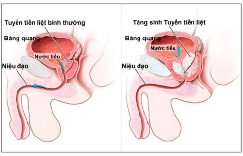 Hình ảnh của bệnh viêm tuyến tiền liệt