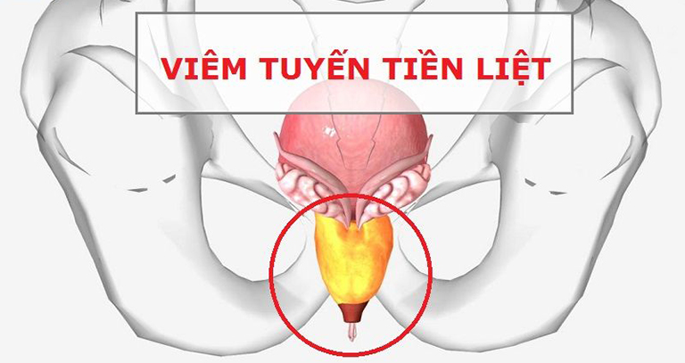 Tinh trùng vón cục là dấu hiệu của bệnh gì?