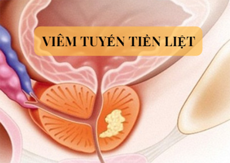 Bệnh viêm tuyến tiền liệt