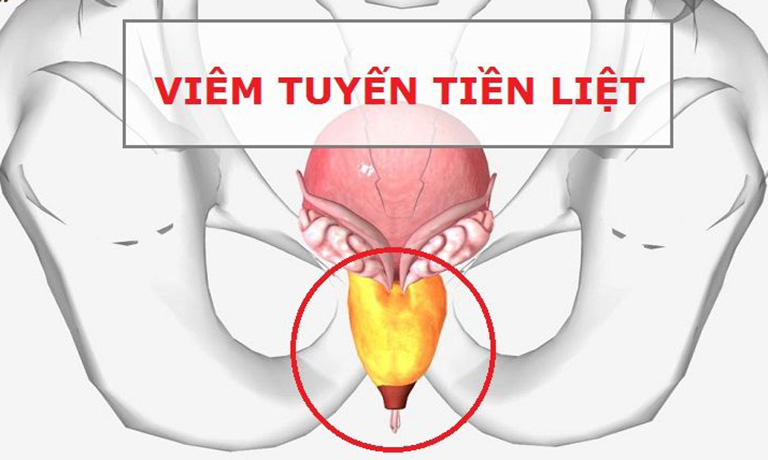 bệnh gây xuất tinh sớm