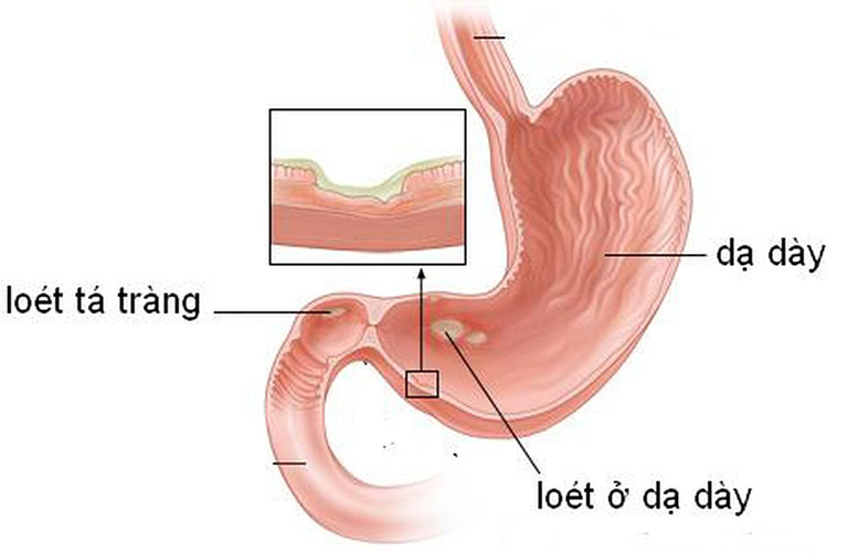 đau bụng âm ỉ kéo dài