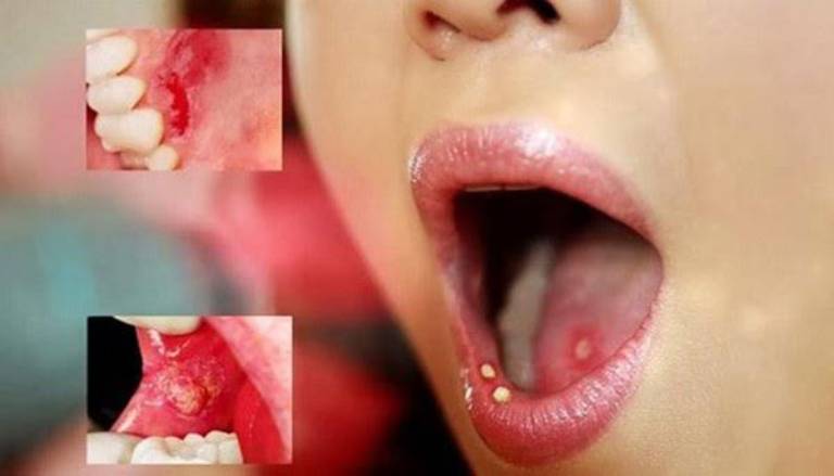 Giang mai gây ra nhiều vấn đề về răng miệng