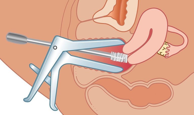 Khám phụ khoa bằng mỏ vịt là gì?