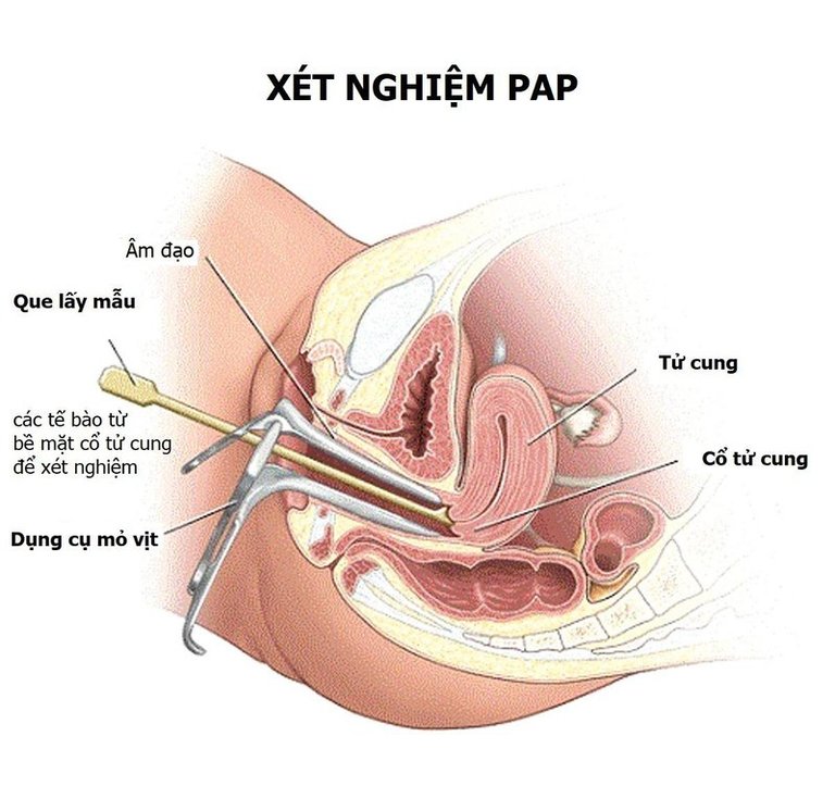 Khám phụ khoa bằng mỏ vịt là bước quan trọng trong quá trình khám