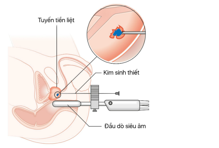 Quy trình khám tuyến tiền liệt